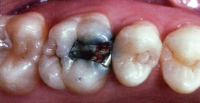 amalgam filling