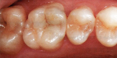 composite filling