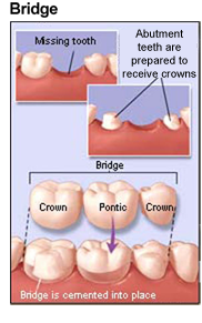 Dental Bridges Diagram