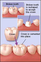 Crowns