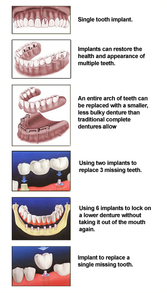 Dental Implants