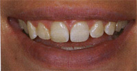 before lumineers /no prep veneers