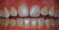minimal preparation of teeth