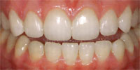 final delivery of lumineers/no-prep veneers