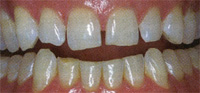 Before Standard Veneers