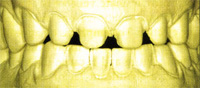mold of standard veneer prep