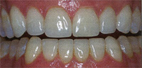 after final delivery of standard veneers