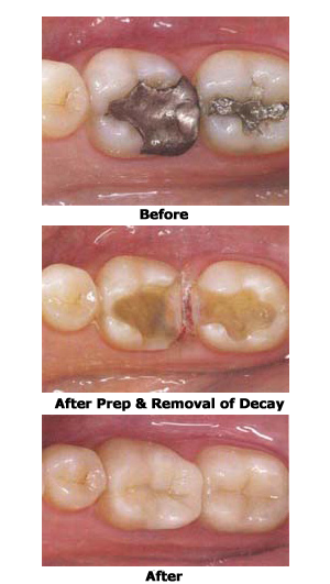 dental onlays