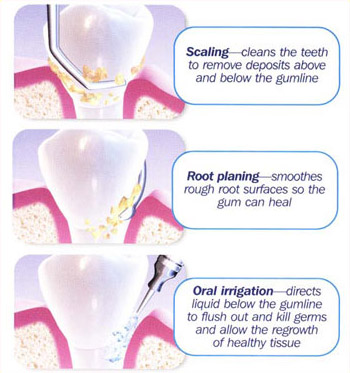 periodontal treatment