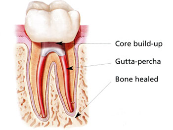 root canal treatment completed