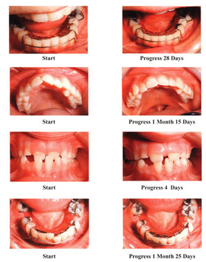 orthodontics without braces